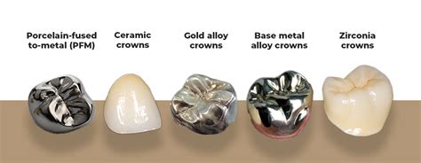 are there different quality of tooth crowns